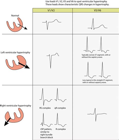 lvh signs on ecg